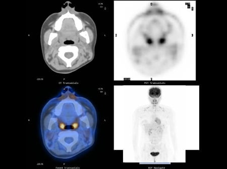 NCCN Task Force Report: PET/CT Imaging (Slides With Transcript)
