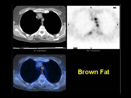 NCCN Task Force Report: PET/CT Imaging (Slides With Transcript)