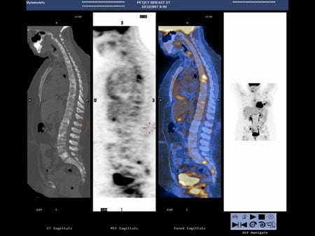 NCCN Task Force Report: PET/CT Imaging (Slides With Transcript)