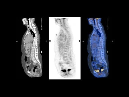 NCCN Task Force Report: PET/CT Imaging (Slides With Transcript)