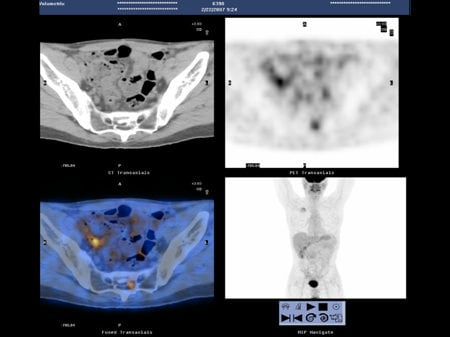 NCCN Task Force Report: PET/CT Imaging (Slides With Transcript)