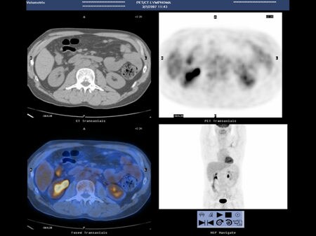 NCCN Task Force Report: PET/CT Imaging (Slides With Transcript)