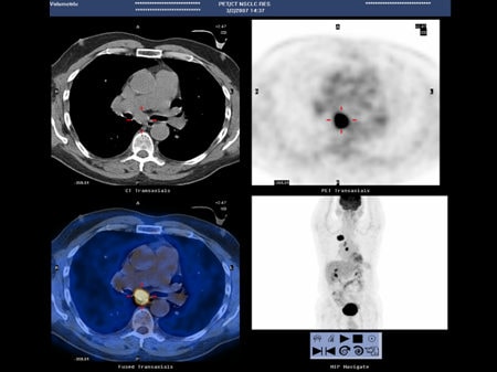 NCCN Task Force Report: PET/CT Imaging (Slides With Transcript)