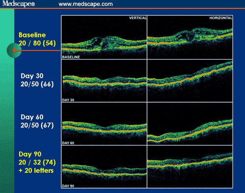 Evaluating the Options for the Treatment of AMD