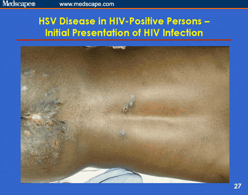Genital Herpes In Persons With Or At Risk For Hiv Infection Prevention And Management For