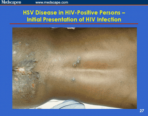 Genital Herpes In Persons With Or At Risk For Hiv Infection Prevention And Management For 