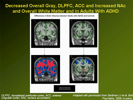 The Evolving Face of ADHD: From Adolescence to Adulthood