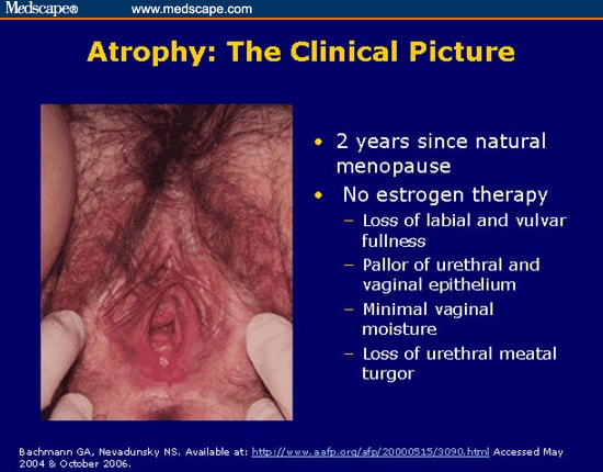 vaginal atrophy discharge