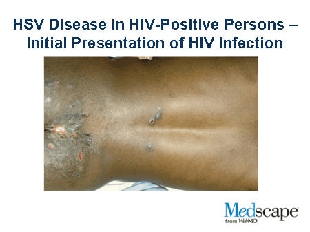 Genital Herpes And HIV: Disease Interactions In 2 Intersecting ...