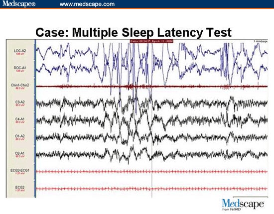 "Doctor, Why Can't I Stay Awake?" Managing Excessive Sleepiness In The ...