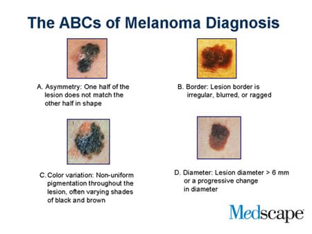 Metastatic Melanoma: Current Treatments & Guidelines