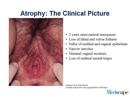 Atrophic vaginitis - Wikipedia