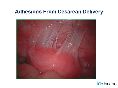 Perspectives on Adhesions Following Cesarean Delivery (Slides/Transcript)