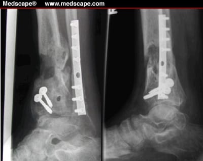 Open Pilon Open Tibial Pilon Fractures: Complications and Issues of Limb Salvage