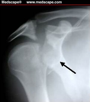 Evaluation and Classification of Proximal Humeral Fractures