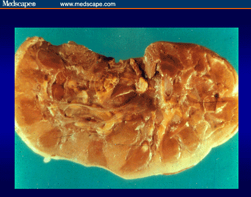 Chronic Rejection: A Case for Optimizing Immunosuppressive Therapy for ...