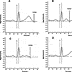 QT Interval: How to Measure It and What Is 