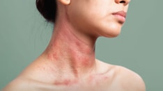 Personalizing the Care of Patients With Atopic Dermatitis and Head and Neck Involvement