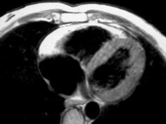 Sudden Cardiac Death in Athletes