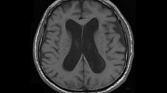clinical case study on covid 19 Common Causes of Altered Mental Status in the Elderly