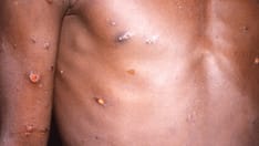 Monkeypox 2022: A Spreading Threat