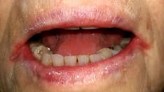 Cutaneous and Mucosal Clues to Nutritional Deficiencies