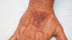 Bacterial Skin Infections: Beneath the Surface