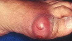 'Tis the Season for Gout