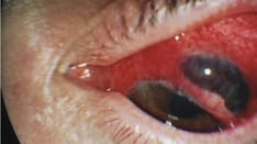 Ocular Trauma: 8 Potentially Devastating Eye Injuries