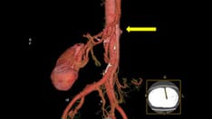 Aortic Dissection: A Double-Barreled Threat