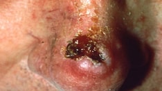 Deadly Skin Cancers