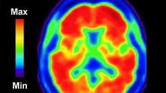 presentation of vascular dementia Alzheimer Disease: Diagnostic Challenges