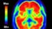 Alzheimer Disease: Diagnostic Challenges