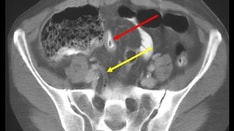 14 Mimics of Appendicitis