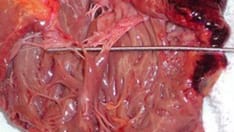 Keys to Diagnosing Broken Heart Syndrome (Takotsubo Cardiomyopathy)