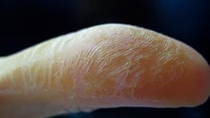 Contact Dermatitis: An Overview