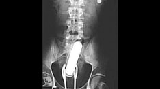 Foreign Bodies in the Gastrointestinal and Genitourinary Tracts: Interesting Images