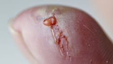 Scorpion Stings: From Mild Local Effects to Death