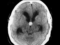Acute Onset of Headache and Blurred Vision in a 16-Year-Old Girl