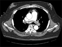 Postoperative Dyspnea in a 59-Year-Old Man