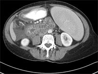 A 68-Year-Old Woman With Recurrent Abdominal Pain, Nausea, and Vomiting