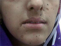 A Teenager With Oral Ulcers, Hyperpigmentation, and Postural Hypotension