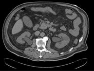 A 75-Year-Old Man With Anuria and Abdominal Distention