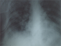 A 28-Year-Old With a Fever of Unknown Origin