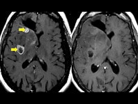 Role of Imaging in Brain Tumors