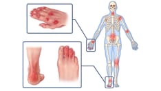 glp-1 and psoriatic arthritis GLP-1s May Lower Cardiac, Mortality Risks in PsA Patients