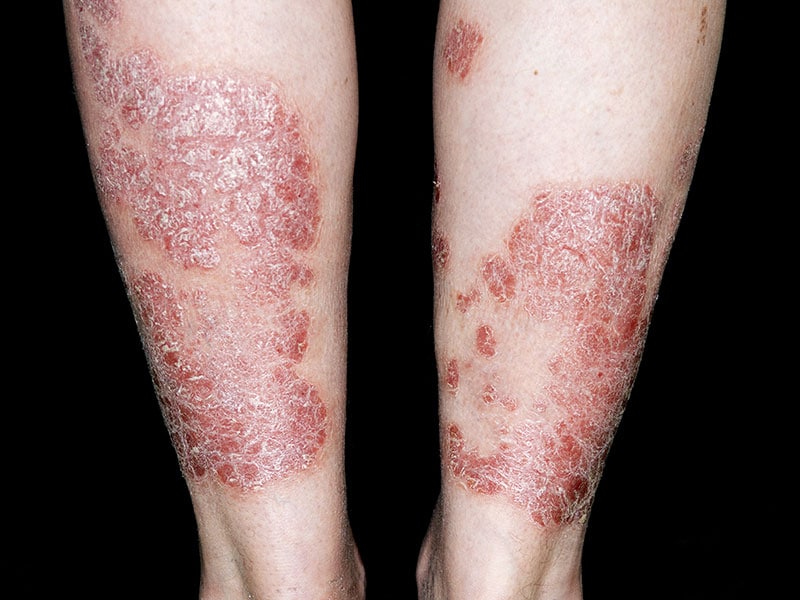 Improving Patient Management in Psoriasis: Focus on a Comprehensive