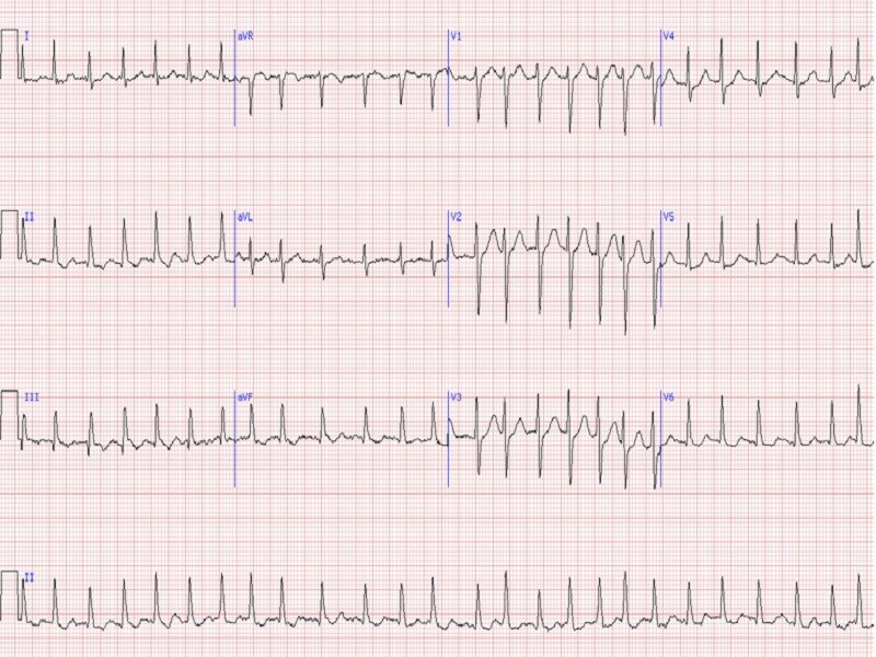 Atrial Fibrillation Center of Excellence | Medscape