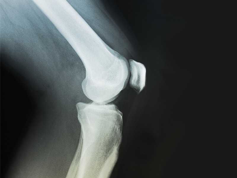 Knowledge and Attitudes Regarding OTC NSAID Use in Patients With Osteoarthritis