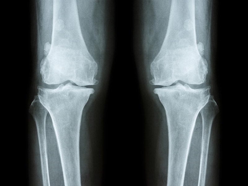 Osteoarthritis Pain Relief Options: Evidence and Perspectives